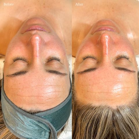 Lux LED Facial